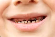 Trẻ sâu răng cẩn thận biến chứng viêm tủy răng gây nguy hiểm
