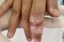 Bé trai bị bỏng tay nặng khi rút điện thoại đang sạc