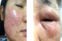 Nhiễm độc da, vô sinh vì dùng mỹ phẩm kém chất lượng