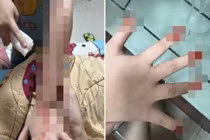 Mắc bệnh lạ, hễ căng thẳng là cơ thể tự chảy máu đầm đìa