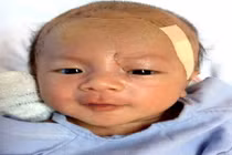 Sức khỏe bé trai bị đâm xuyên não có dấu hiệu bất thường