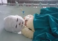 Bị bỏng vì mẹ bất cẩn khi đun bếp than