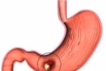 Đại tiện phân đen có nguy hiểm hay không?