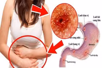 Đau dạ dày nên tránh tuyệt đối những thực phẩm này