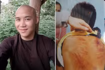 Giám định thương tật cháu bé tố thầy tu đánh đập