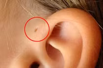 Mối nguy từ lỗ nhỏ hay bị bỏ qua ở vành tai