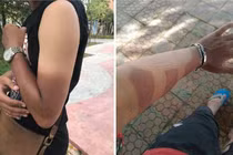Dân mạng đua nhau khoe hình xăm dạng cháy nắng: “Thế giới này thật đáng sợ“!