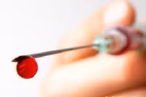 Việc lây nhiễm HIV qua đường máu xảy ra như thế nào?