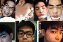 Dao kéo toàn bộ khuôn mặt để trở thành hotboy