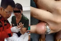 Cận cảnh ngón tay viêm lở khủng khiếp vì đeo nhẫn chật