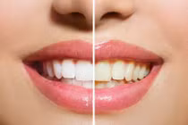 Thủ phạm khiến răng vàng khè mà bạn không ngờ đến