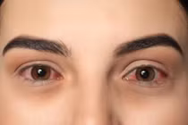 Đau mắt đỏ lây qua đường nào?