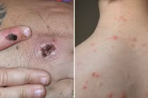 Điểm khác biệt nhất giữa bệnh đậu mùa khỉ và thủy đậu