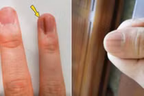 Dấu hiệu khác thường trên móng tay cảnh báo bệnh nguy hiểm