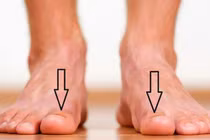 Dấu hiệu nhỏ trên bàn chân cảnh báo "trọng bệnh"