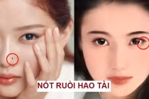 5 nốt ruồi hao tài phá lộc khiến chủ nhân dễ tán gia bại sản