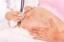 Viêm phổi và loạt biến chứng nguy hiểm của thủy đậu ở bà bầu