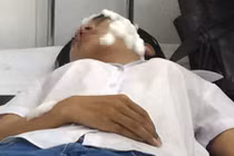 Mâu thuẫn tình ái, hai nữ SV bị tạt axit trên đường đi học