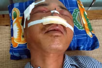 Đi ăn tối bị côn đồ bắt trả tiền, đánh vỡ mặt 
