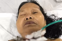 Phụ cháu mổ gà, bà nội trượt chân bị dao đâm xuyên cổ