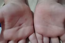 Cô giáo mầm non bị tố dùng vật nhọn đâm vào tay bé trai 5 tuổi