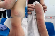 Khởi tố ông bố đánh con gái thâm tím người ở Vĩnh Phúc