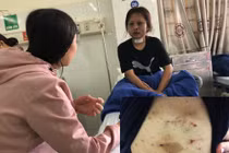Từ chối tiếp khách, thiếu nữ bị "tú ông" tra tấn dã man suốt 2 ngày