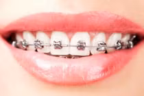 Cận cảnh quá trình niềng răng ít người biết