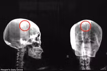 Kinh hãi người phụ nữ bị kẹt kim dài 5 cm trong đầu