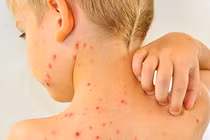 Dấu hiệu chứng tỏ bạn đã mắc bệnh sốt xuất huyết 