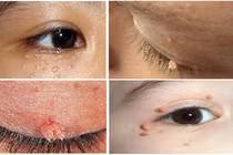 Những hình ảnh khủng khiếp do bệnh sùi mào gà gây ra