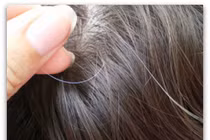 Nhìn vị trí tóc bạc sớm đoán nhiều bệnh nan y