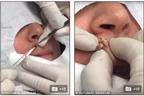 Kinh hãi những cảnh nặn mụn khổng lồ 