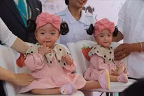 Hình ảnh Trúc Nhi - Diệu Nhi sau 9 tháng phẫu thuật tách rời