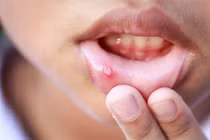 Những thói quen số một gây ung thư miệng