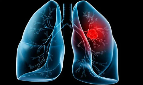 Đây chính là 10 bệnh ung thư đàn ông Việt mắc nhiều nhất