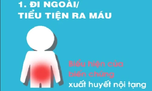 Dấu hiệu khi mắc sốt xuất huyết cần nhập viện ngay