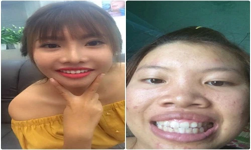 Phượng "Thị Nở" khoe răng cũ lởm khởm để PR răng mới