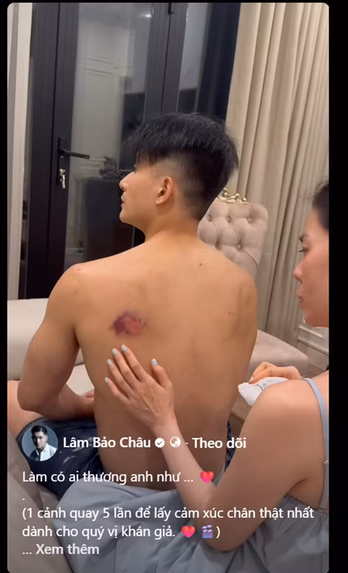 Sau khi phim Chị ngã em nâng ra rạp, Lâm Bảo Châu tiết lộ hình ảnh bị thương trong lúc quay dự án. Ảnh: FB Lâm Bảo Châu.