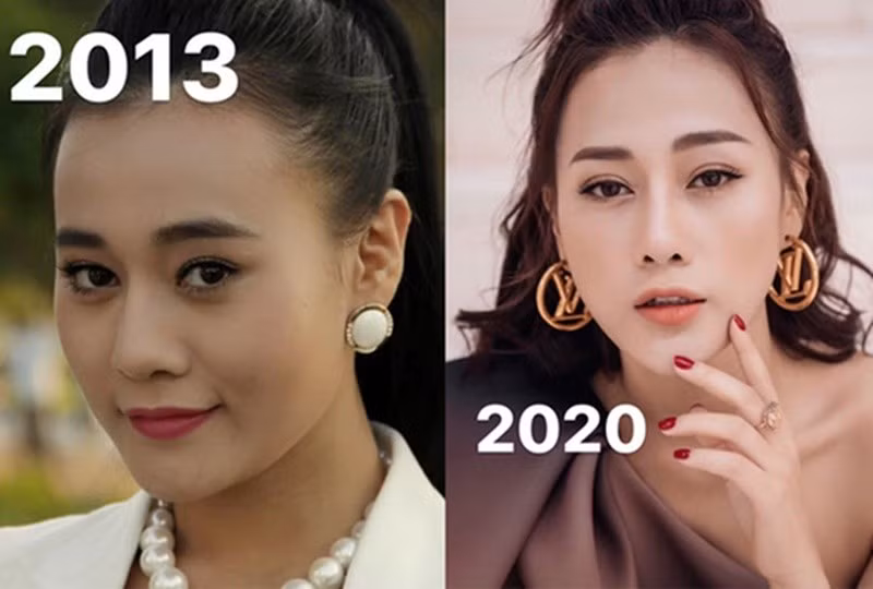 "Thông thường, một gương mặt sau khi phẫu thuật sẽ phải mất 2 - 3 tháng mới có thể hoàn thiện và 6 tháng mới trông thật hoàn hảo. Tôi tin rằng sau khoảng thời gian này, khi các nét trở nên hài hòa, mình sẽ không khiến mọi người thấy thất vọng hay xa lạ vì diện mạo mới", Hoa Học Trò dẫn lời Phương Oanh. Ảnh: Vietnamnet.