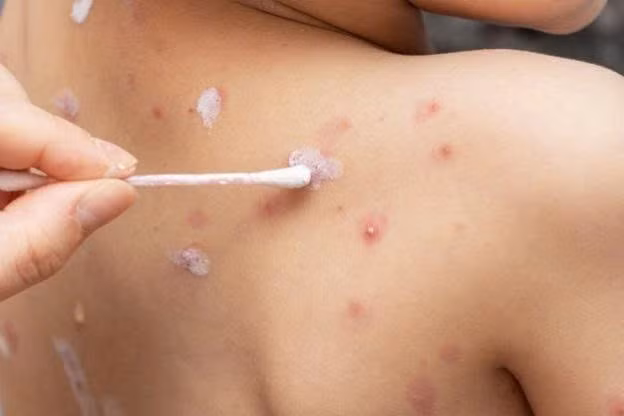 Khi bị thủy đậu, việc kiêng ăn một số loại thực phẩm có thể giúp người bệnh hồi phục nhanh hơn và tránh tình trạng sẹo. Dưới đây là danh sách các loại thực phẩm cần tránh trong quá trình trị bệnh thủy đậu. Ảnh VNC