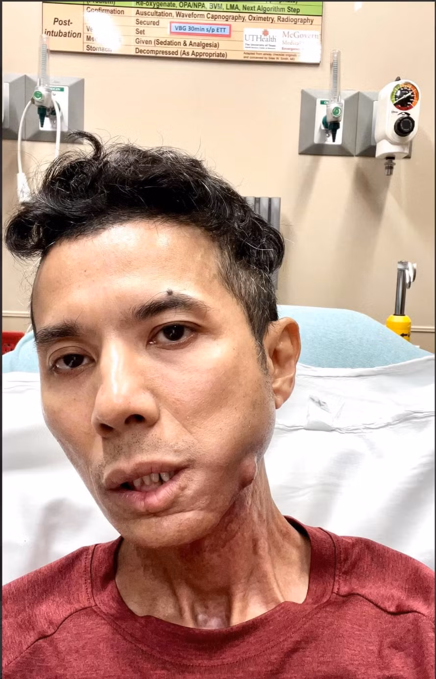 Bệnh viêm khớp xương hàm của Kasim Hoàng Vũ nguy hiểm thế nào? Benh viem khop xuong ham cua Kasim Hoang Vu nguy hiem the nao?