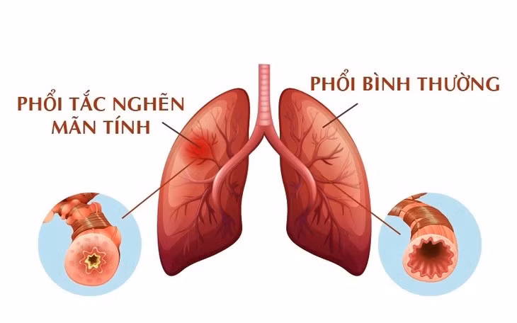 Cách đối phó với bệnh phổi tắc nghẽn hơn 380 triệu người mắc Cach doi pho voi benh phoi tac nghen hon 380 trieu nguoi mac