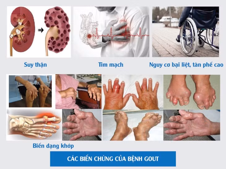 Cach phong ngua benh gut tai phat