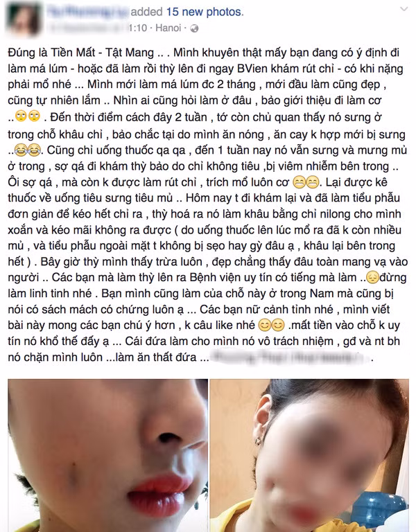 Nhấn má lúm, một trong những trào lưu làm đẹp gây sốt trong thời gian qua. Dưới sự quảng cáo hấp dẫn và chiêu trò khuyến mại, giảm giá của nhiều thẩm mỹ viện với mức giá vài trăm nghìn cho một ca nhấn má, không ít chị em nhẹ dạ cả tin đã phấn khởi thực hiện để rồi kết quả nhận lại quá đắng lòng. Bức ảnh của một cô gái nhấn má bị mưng mủ, mặt biến dạng được chia sẻ rộng rãi trên khắp các diễn đàn dao kéo trong vài ngày gần đây đang là hồi chuông cảnh tỉnh cho nhiều phụ nữ đang ấm ủ ước mơ phẫu thuật thẩm mỹ với giá rẻ.