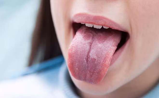 Lưỡi có thể tiết lộ tình trạng sức khỏe đang gặp vấn đề gì? - Hình 3 Luoi co the tiet lo tinh trang suc khoe dang gap van de gi?-Hinh-3