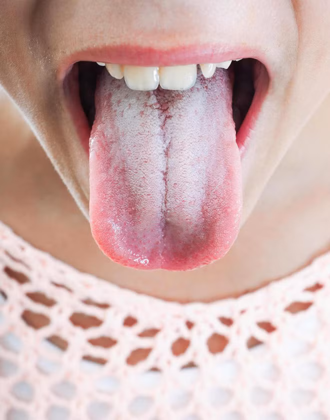 Lưỡi có thể tiết lộ tình trạng sức khỏe đang gặp vấn đề gì? - Hình 2 Luoi co the tiet lo tinh trang suc khoe dang gap van de gi?-Hinh-2