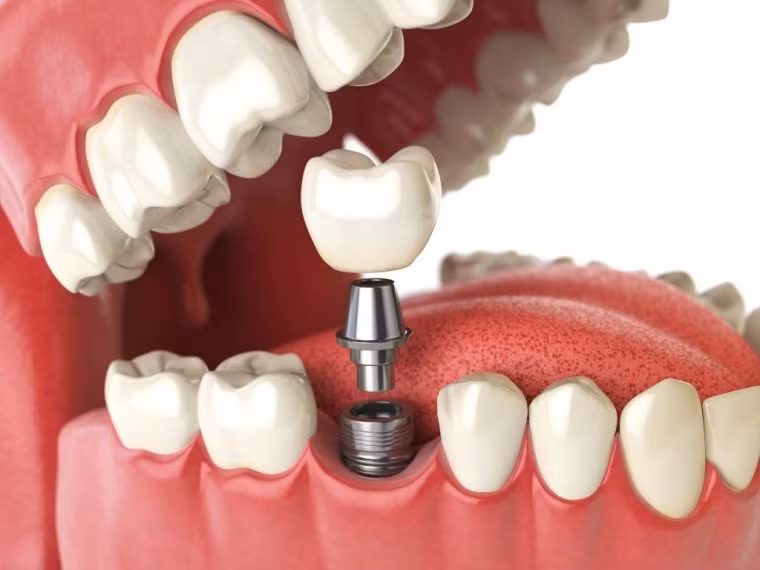 Phương pháp trồng răng implant có tác dụng phục hồi lại răng bị mất hoàn toàn. Ảnh: nhakhoanacera.