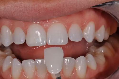 Việc dán răng sứ dễ thực hiện và đơn giản hơn nhiều các phương pháp khác. Ảnh: niengrangkhongmaccai.