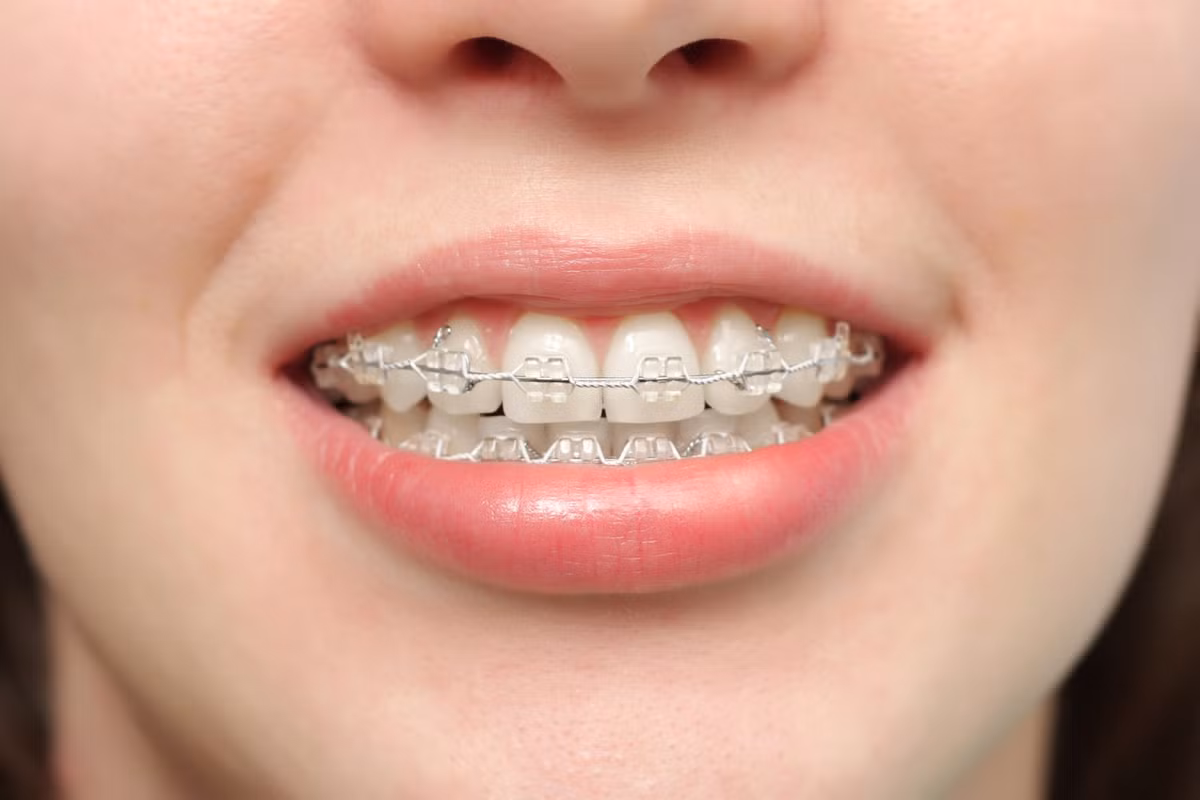 Đây là phương pháp an toàn và hiệu quả với những trường hợp lệch lạc về răng như hô, móm, răng mọc chen chúc…Ảnh: nhakhoanhatminh.